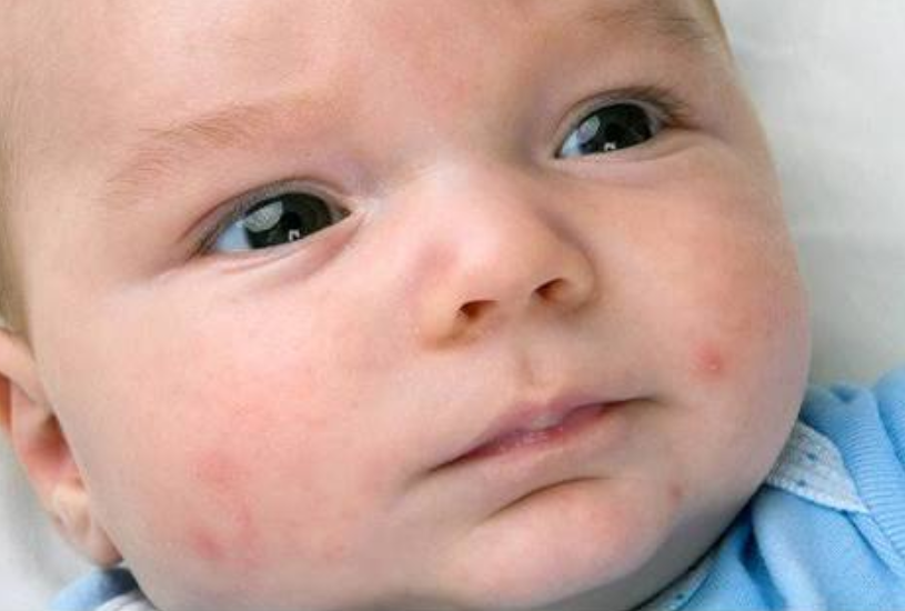 Common Causes Of Red Spots On Baby Skin! AIRCLINIC